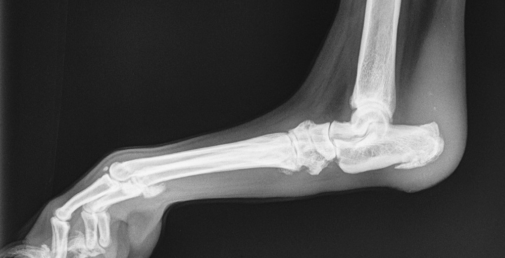 Achilles injury treatment
