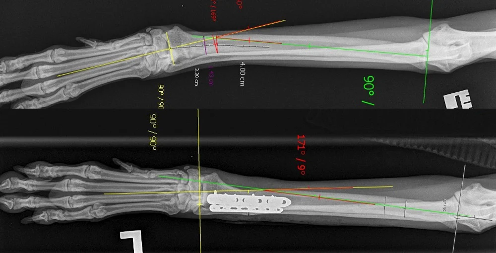 Bone deformity treatment