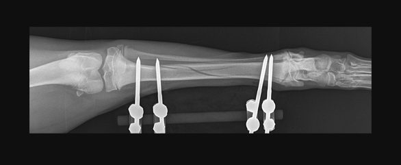 Fixator Surgery After