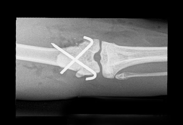 Pins Surgery After