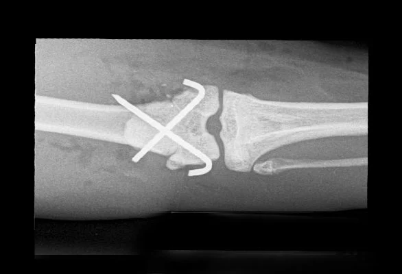 Pins Surgery After