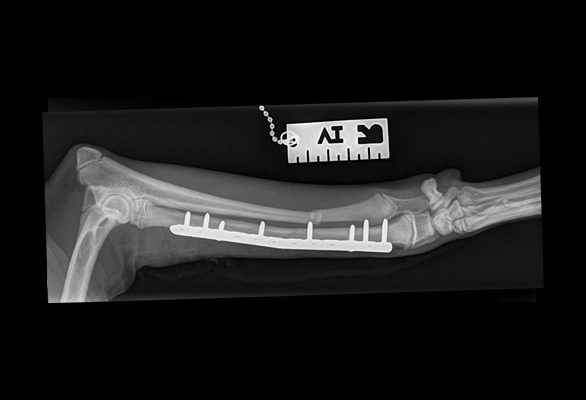 Plate Surgery After