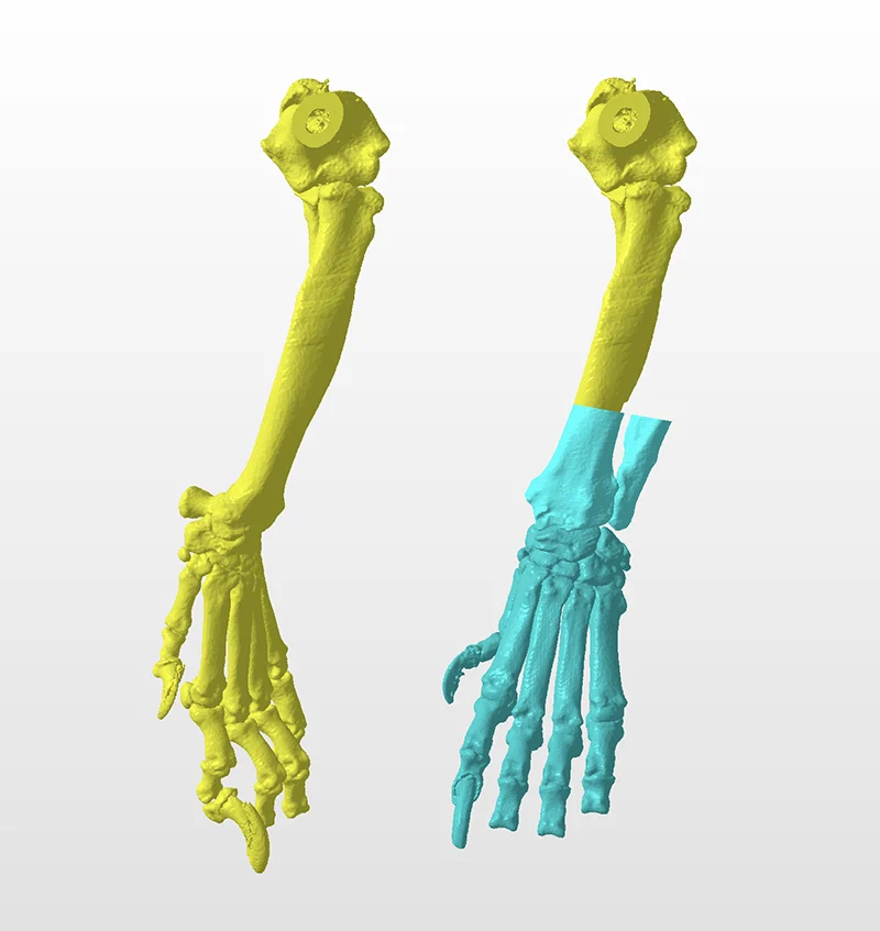 CT Assessed Deformity