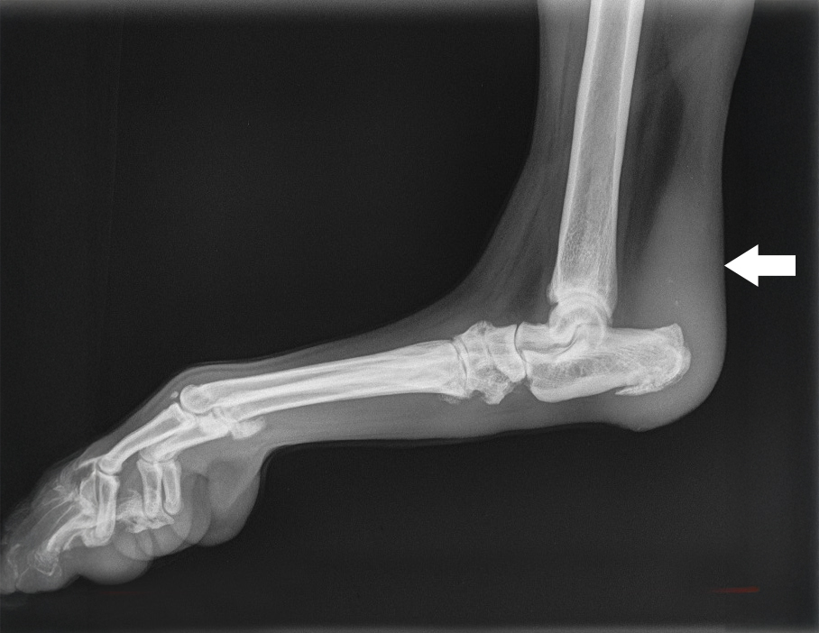 Achilles Injury treatment